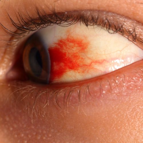 Diabetic Retinopathy