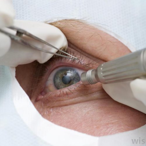 Corneal Erosion