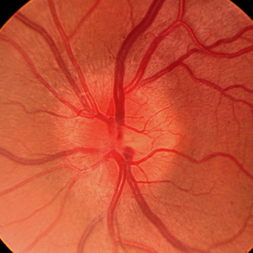 1504 Optic Neuritis