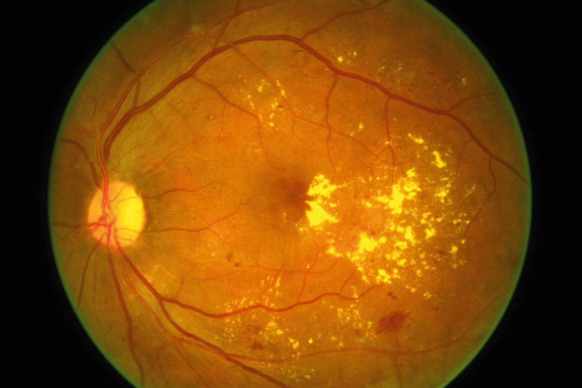 Diabetic Macular Oedema