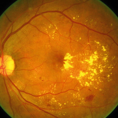 Diabetic Macular Oedema