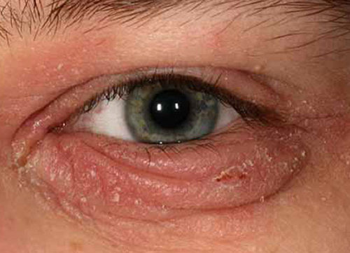 Blepharitis