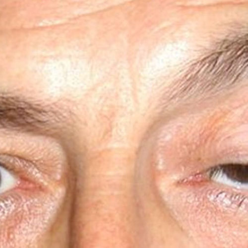 Ptosis