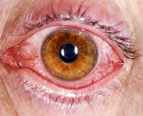 Conjunctivitis