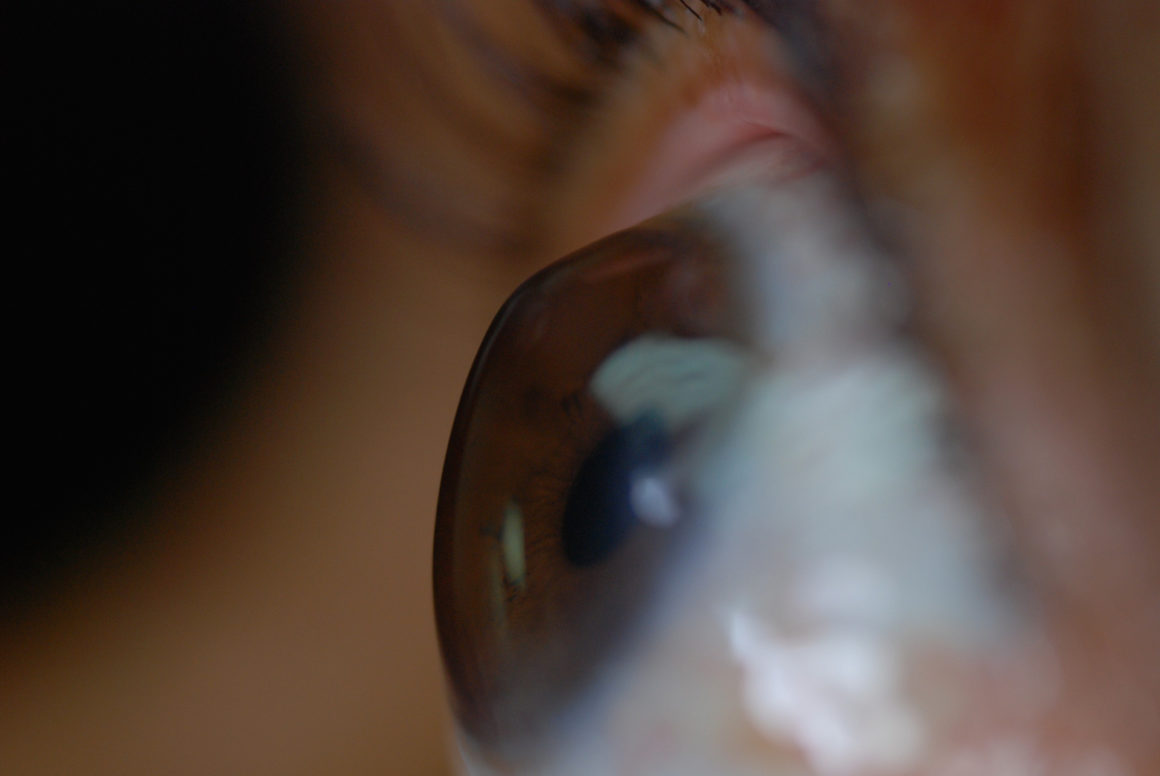 Keratoconus