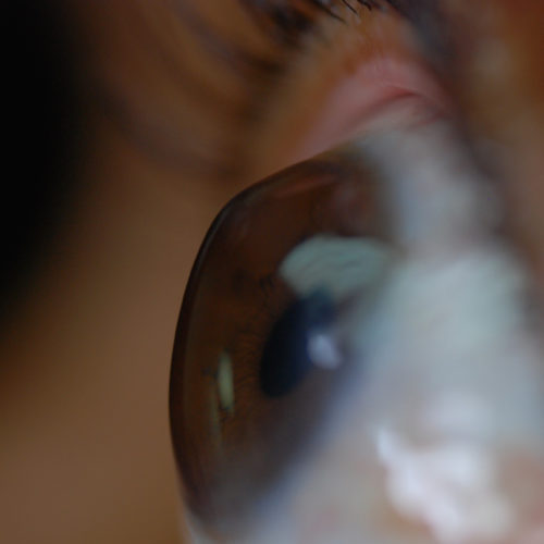 Keratoconus