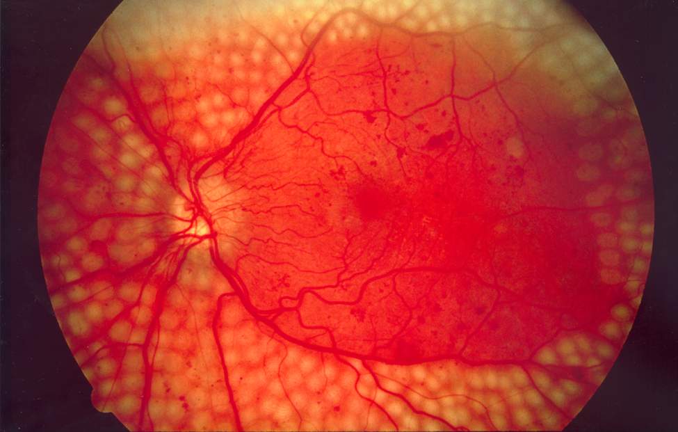 Fundus_photo_showing_scatter_laser_surgery_for_diabetic_retinopathy_EDA09