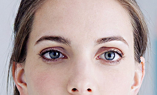 Strabismus