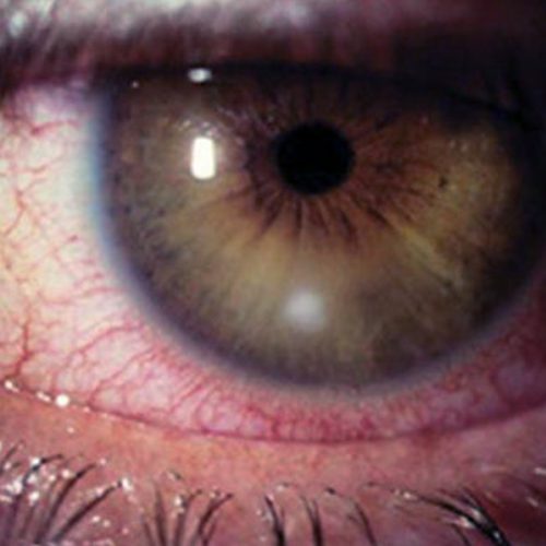 Corneal Ulcer
