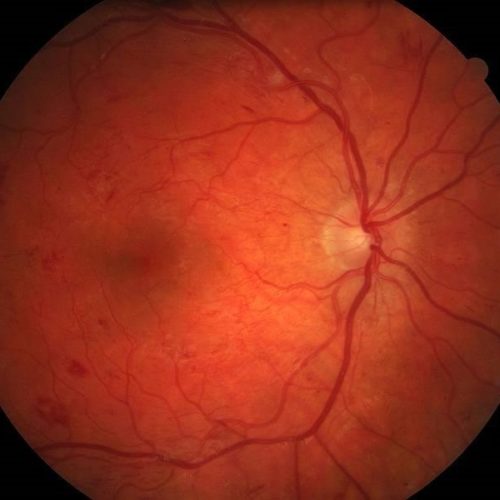 diabetic retinopathy Diabetic Retinopathy