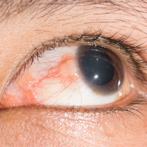 Scleritis