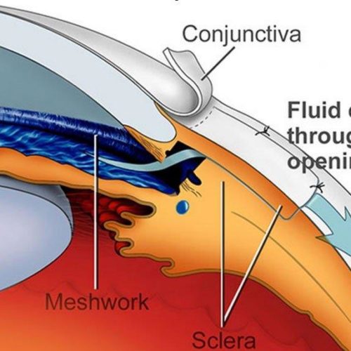Glaucoma Surgery