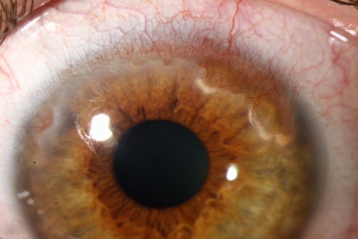 Corneal Neovascularisation