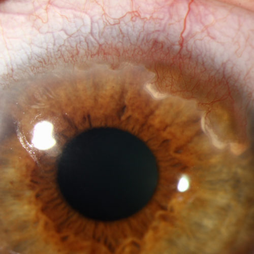 Corneal Neovascularisation