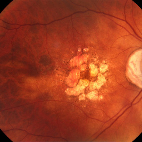 macula-with-macular-degeneration Macular Degeneration