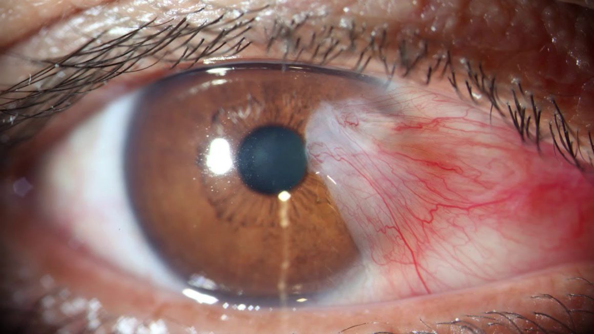 Pterygium