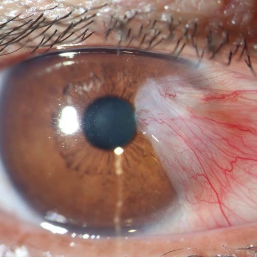 Pterygium Surgery