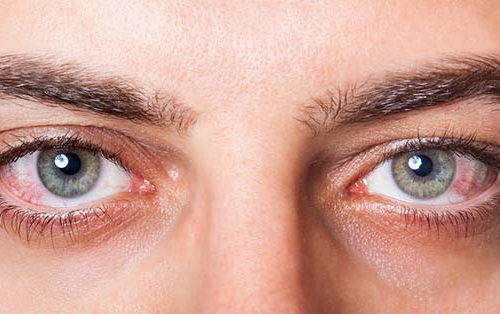 Uveitis