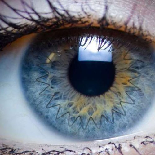 Corneal Cross-Linking (Keratoconus)